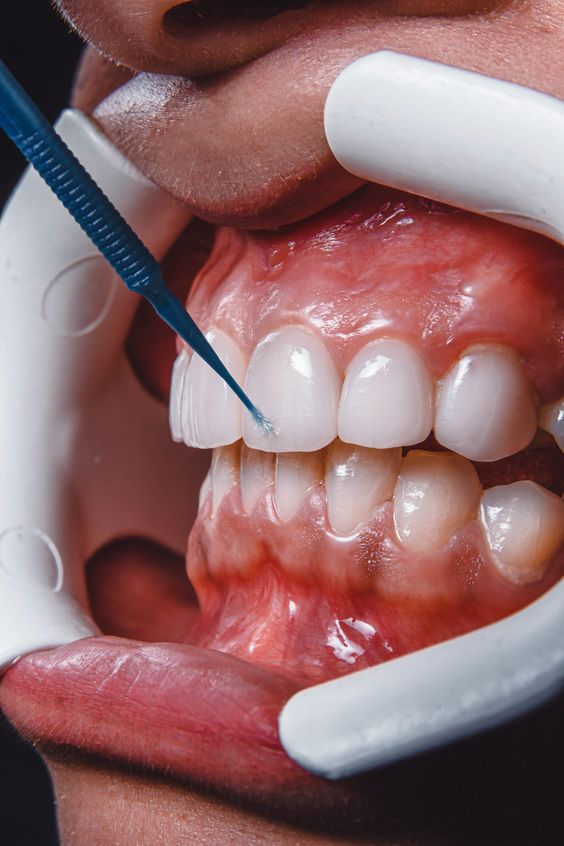 تفاوت بین بلیچینگ و جرم‌گیری دندان چیست؟ 
