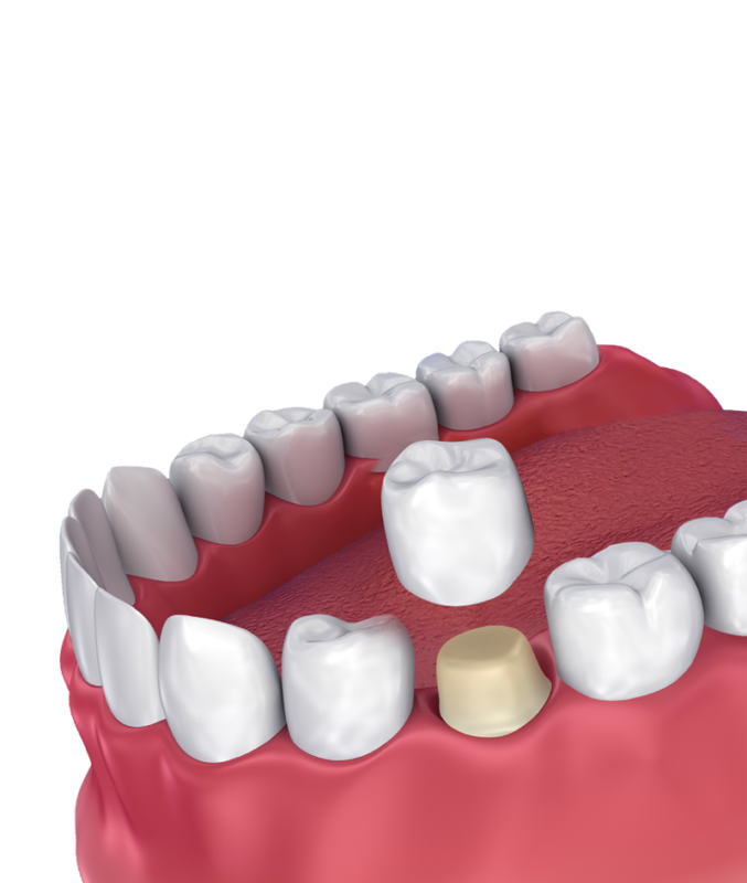 Single Dental Crown