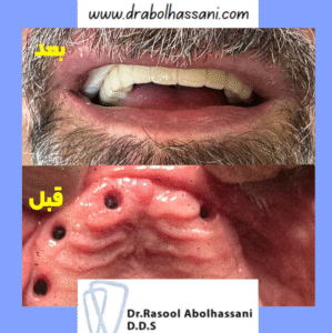 ایمپلنت دندان