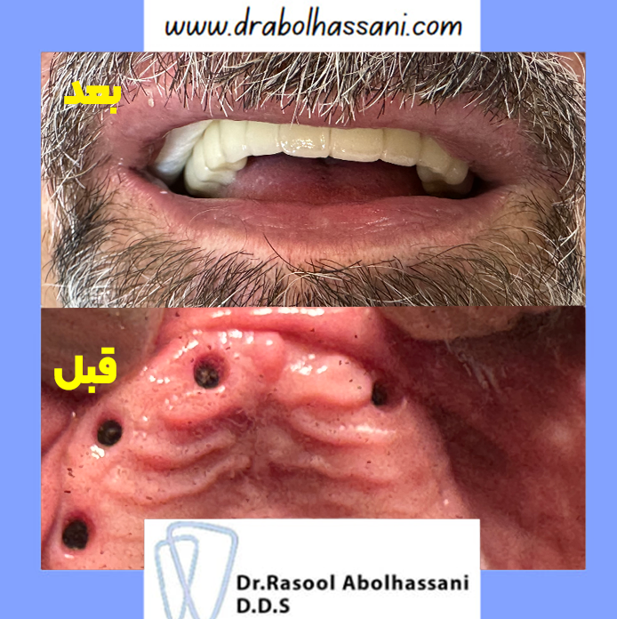 ایمپلنت دندان