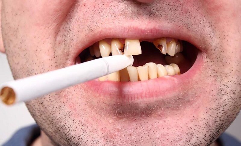 تا چند روز بعد از جراحی ایمپلنت نباید سیگار کشید؟